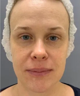 WOW-effect procedure