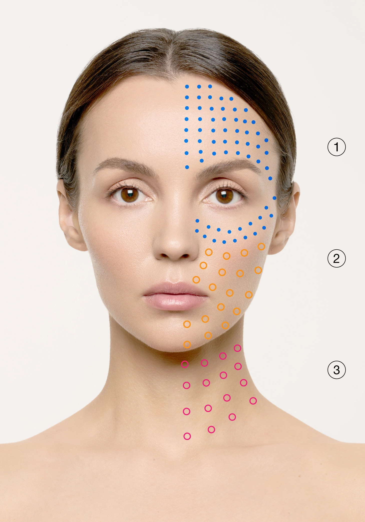 Pigmentation, Rosacea