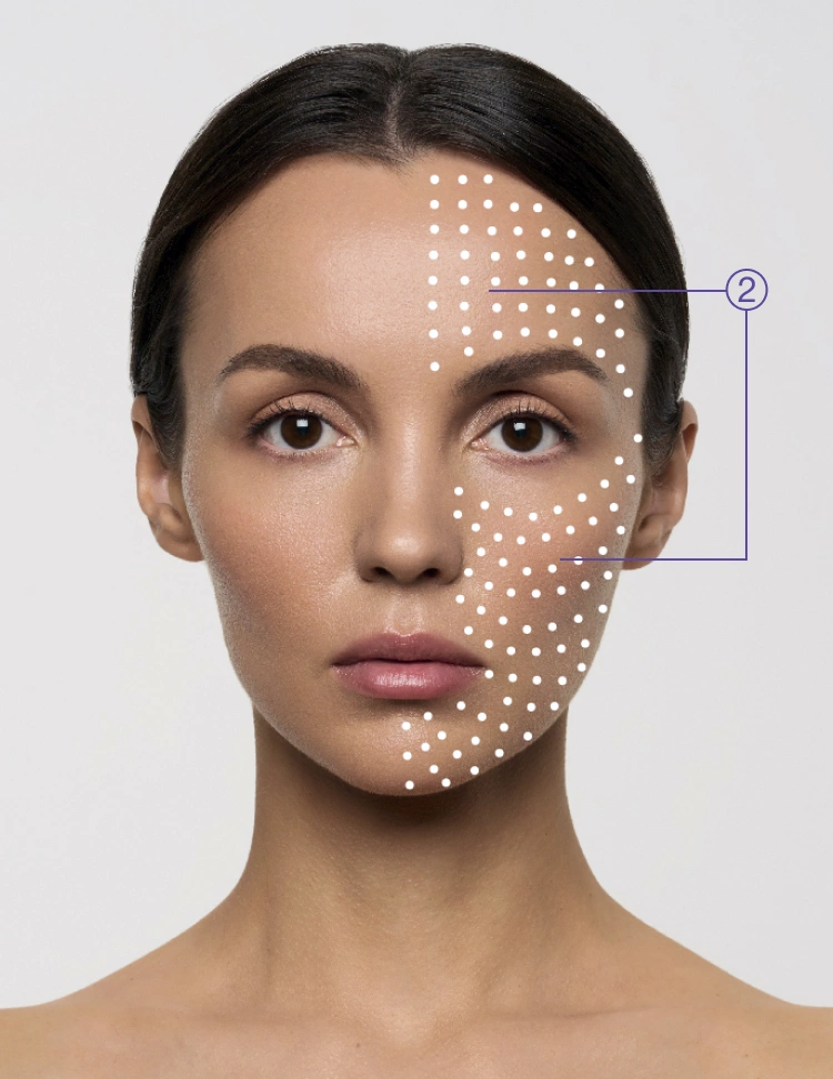 Micropapular Technique